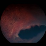 A spotty retina!